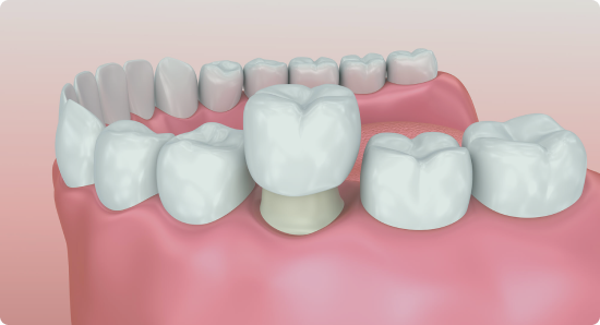 Металлокерамические коронки на зубах - особенности